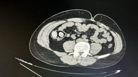 Bu kadarına da pes: Midelerinden 10 parça halinde uyuşturucu çıktı