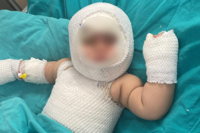 Patlayan domates konservesi 9 aylık bebeği yaktı