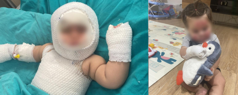 Patlayan domates konservesi 9 aylık bebeği yaktı